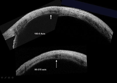 Figure 4. Montage image of anterior segment OCT of case 1