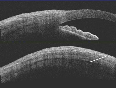 Figure 5. Anterior segment OCT of case 2