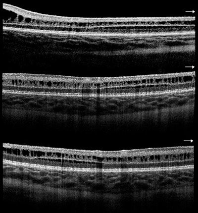 Figure 1. Three images showing retinal splitting (schisis) and cystic maculopathy (black spaces).