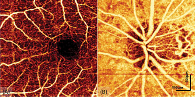 Figure 2. In vivo 3-D volumetric OCT angiography of the macula and the optic nerve head.