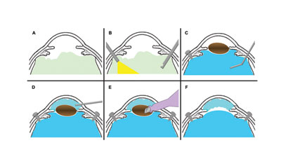 Figure 1. Schematic representation of visco-perfluorocarbon sandwich technique.