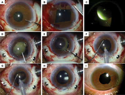 Figure 2. Surgical steps in a case of Marfan syndrome with a subluxated cataractous lens.