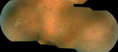 Figure 1. Fundus photograph of the right eye. 