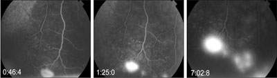 Figure 2. Fluorescein angiography of the right eye. 