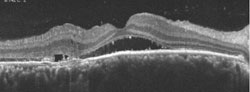 Figure 3. Macular OCT of the right eye.