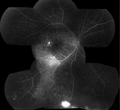 Figure 4. Fluorescein angiography of the right eye. 