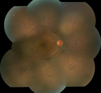 Figure 5a. Fundus photograph of the right eye. 