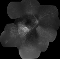 Figure 5b. Fluorescein angiography of the right eye. 