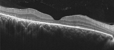 Figure 6. Macular OCT of the right eye.