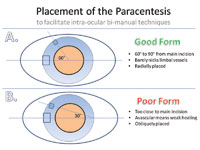 Figure 1. Paracentesis incisions should have specific characteristics (A) and not others (B).