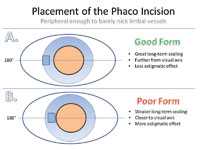 Figure 2. The corneal phaco incision should barely nick the limbal vessels (A). If it is too close to the visual axis (B) it can induce significant astigmatism.