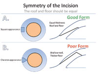 Figure 3. A good, symmetric incision has an equal thickness of the roof and floor (A), whereas a poorly balanced incision has a chevron appearance (B).