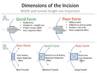 Figure 4. The corneal phaco incision should have the correct width (A) and tunnel length (B) for best results.