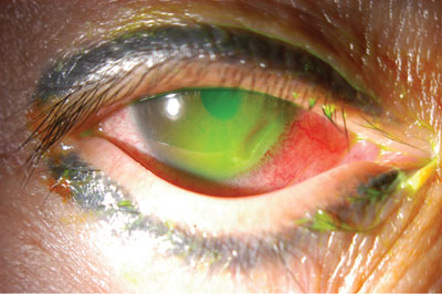 Figure 1. Color photograph of the right eye. Conjunctival injection is present with associated perilimbal epithelial ulceration and thinning. 