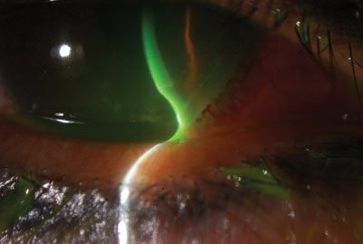 Figure 2. Slit lamp color photograph of the right eye. 