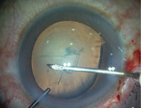 Scleral flap has been created centered on the area of dialysis.