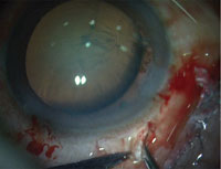 Sclerotomy is made under the scleral flap with a 20-gauge needle