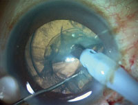 The haptic is tucked into a Scharioth scleral tunnel to stabilize the bag