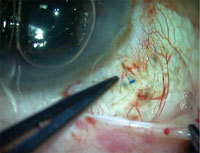 The haptic can be seen tucked in a coat hanger manner into the scleral tunnel.