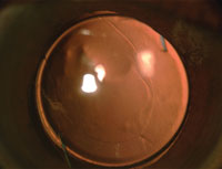 Postoperative appearance of the same eye at 3 months showing a well-centered bag and BCVA of 6/6.