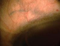 At 6 months postop, the blue color of the haptic can be seen under the scleral flap and conjunctiva.