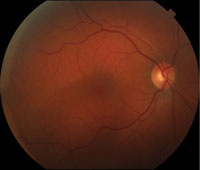 Fundus photograph of the right eye demonstrated an oval-shaped orange-red lesion inferotemporal to the fovea. 