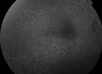 IVFA (22.2 sec) demonstrated early faint, mottled hyperfluorescence. 