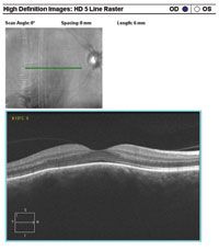 OCT demonstrated elevation of the subfoveal choroid. 