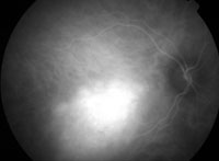 ICG angiography (48.9 sec) demonstrated a well-defined area of early intense, uniform hyperfluorescence.