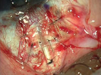 Tube migration is avoided by an oblique passage through the sclera, an anchoring scleral stay suture and a tight flap.