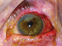 Photograph, left eye. Two pigmented lesions were present with significant injection of the surrounding temporal conjunctiva. 