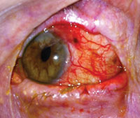 Photograph, left eye. Two pigmented lesions were present with significant injection of the surrounding temporal conjunctiva. 