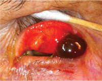 Photograph, left eye. A darkly pigmented, nodular lesion was seen with eversion of the upper lid. 