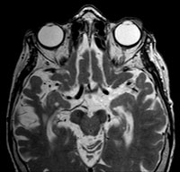 T2-weighted axial MRI, non-contrast. 