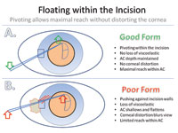 Floating within the phaco incision and using a pivoting technique allow maximal reach and control during surgery.