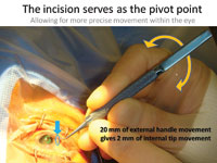 By using the pivoting technique during capsulorrhexis creation, this surgeon shows that a large 20-mm movement of the external instrument handle gives a very precise 2-mm movement