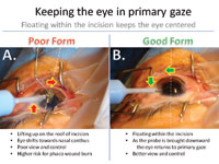 If the surgeon lifts up on the temporal incision, the eye will tend to move toward the nasal canthus (a), which limits the view and control and poses a higher risk for a phaco wound burn.