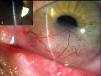 Clinical photograph of extensive inferior corneal neovascularization extending to the central cornea