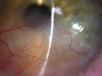 Slit lamp photograph displaying significant corneal thinning in the inferior half of the cornea.