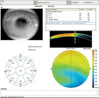 Corneal OCT shows inferior corneal thinning.