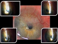 Main figure (surgeon’s view) shows extensive inferior corneal neovascularization, with fleshy, thick pannus extending to central cornea 