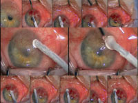 A single freeze-thaw application of cryotherapy over the involved portions of the cornea. 