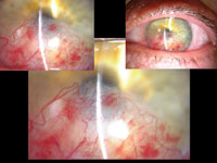 Day 1 postop slit-lamp views showing scattered hemorrhages with an absence of active blood flow clinically. 