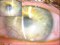 Three weeks after corneal cryotherapy, vision improved from 20/100 to 20/60, and pinhole to 20/40+2. IOP was 15 mm Hg. 