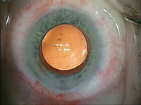 A clear capsule and a nice, round capsulotomy result from femto use. 