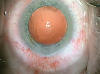 Well-positioned IOL with symmetrical capsulotomy and full overlap of IOL haptic. 