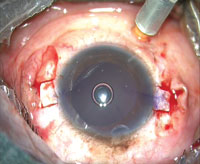 Figure 1. The scleral flaps should be 180° apart. These flaps are about 160° apart, which will lead to a decentered IOL.