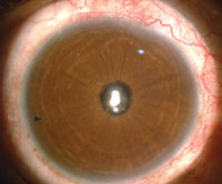 Figure 4. Postop picture (1.5 years) of a glued IOL case done well.