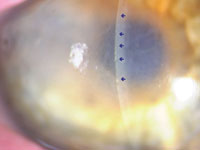 Figure 1. Preoperative slit-lamp photo displaying extensive, diffuse stromal and epithelial edema. 