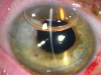 Figure 10. Slit-lamp photograph on postoperative day 1